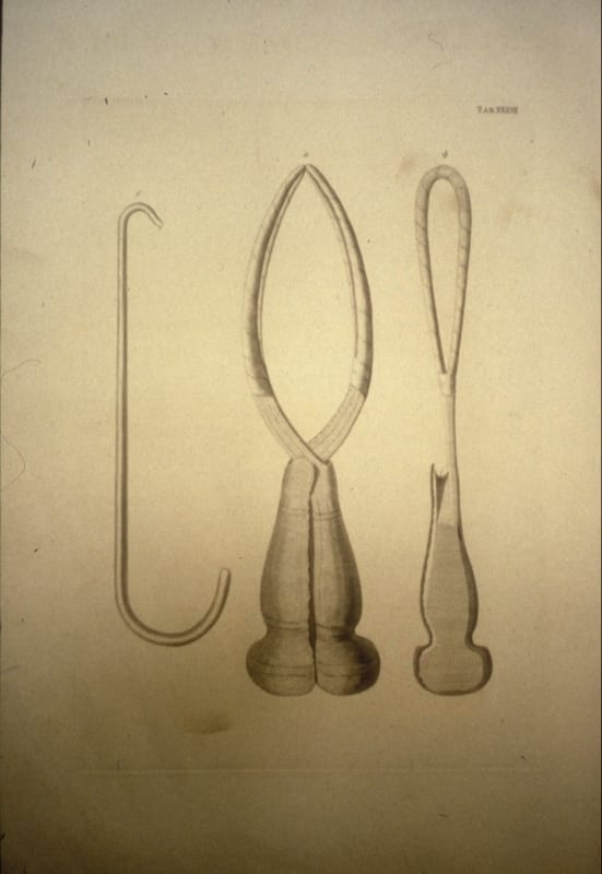 Forceps (centre) developed by William Smellie